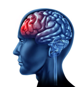 Understanding the emotional, physical, and cognitive symptoms of a concussion