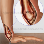 Colles fracture Settlement Value