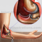 Dislocation of Elbow Joint Settlement Value