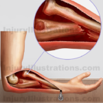 Monteggia fracture anterior dislocation of the radial head with anterior angulation of fractured ulnar shaft