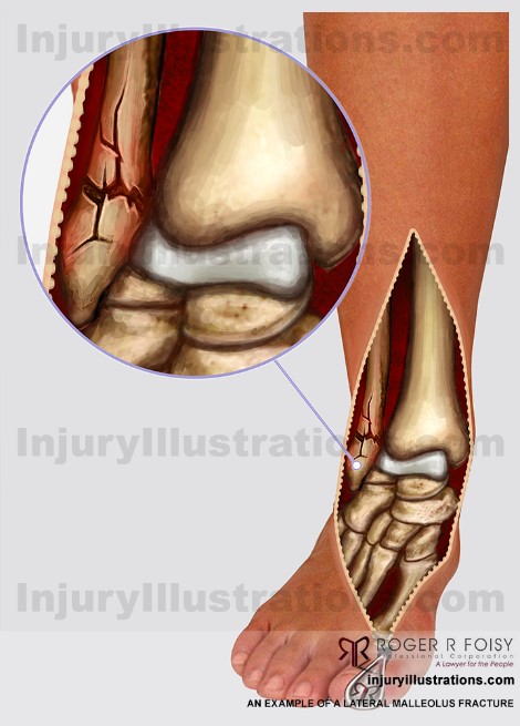 pain intermittently lateral malleolus fracture